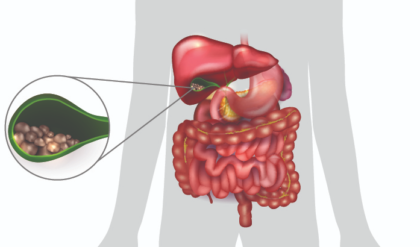 পিঠে বা পেটে অসহ্য যন্ত্রণা? পিত্তথলিতে পাথর জমার এই ৫টি লক্ষণ চিনতে ভুল করবেন না!