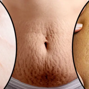 ত্বকের জেদি ফাটা দাগ নিয়ে চিন্তিত? মাত্র কয়েক দিনেই ম্যাজিক দেখাবে এই ঘরোয়া টোটকা!