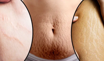 ত্বকের জেদি ফাটা দাগ নিয়ে চিন্তিত? মাত্র কয়েক দিনেই ম্যাজিক দেখাবে এই ঘরোয়া টোটকা!