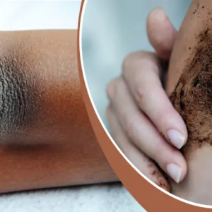 কনুইয়ের বিশ্রী কালো দাগ নিয়ে লজ্জায় হাত গুটিয়ে রাখছেন? রাতারাতি উজ্জ্বলতা ফেরাবে এই ঘরোয়া টোটকা!