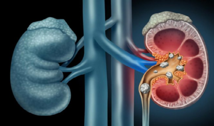 জল কম খাচ্ছেন? অজান্তেই কিডনিতে পাথর জমছে না তো? লক্ষণগুলো চিনে নিন এখনই