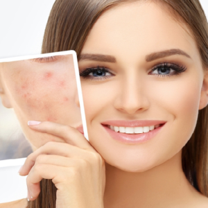 কাল সকালেই অনুষ্ঠান আর মুখে ব্রণের বিশ্রী দাগ? ১ রাতেই দাগ কমানোর জাদুকরী সমাধান! কাল সকালেই অনুষ্ঠান আর মুখে ব্রণের বিশ্রী দাগ? ১ রাতেই দাগ কমানোর জাদুকরী সমাধান!