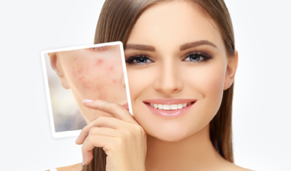 কাল সকালেই অনুষ্ঠান আর মুখে ব্রণের বিশ্রী দাগ? ১ রাতেই দাগ কমানোর জাদুকরী সমাধান!