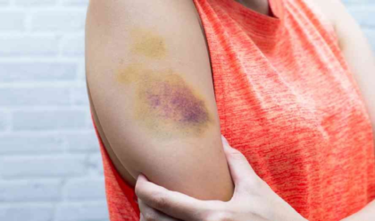 শরীরে কি হঠাতই কালশিটে দাগ পড়ছে? অজান্তেই বড় কোনো রোগ বাসা বাঁধছে না তো!